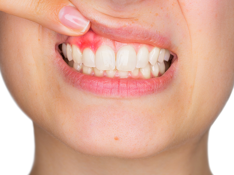 mouth ulcer