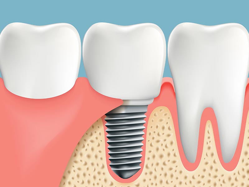 Dental implants