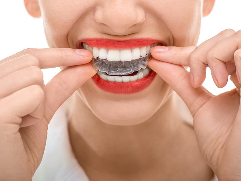 Quick straight teeth