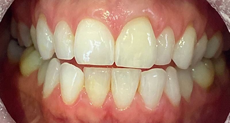 Invisalign Before