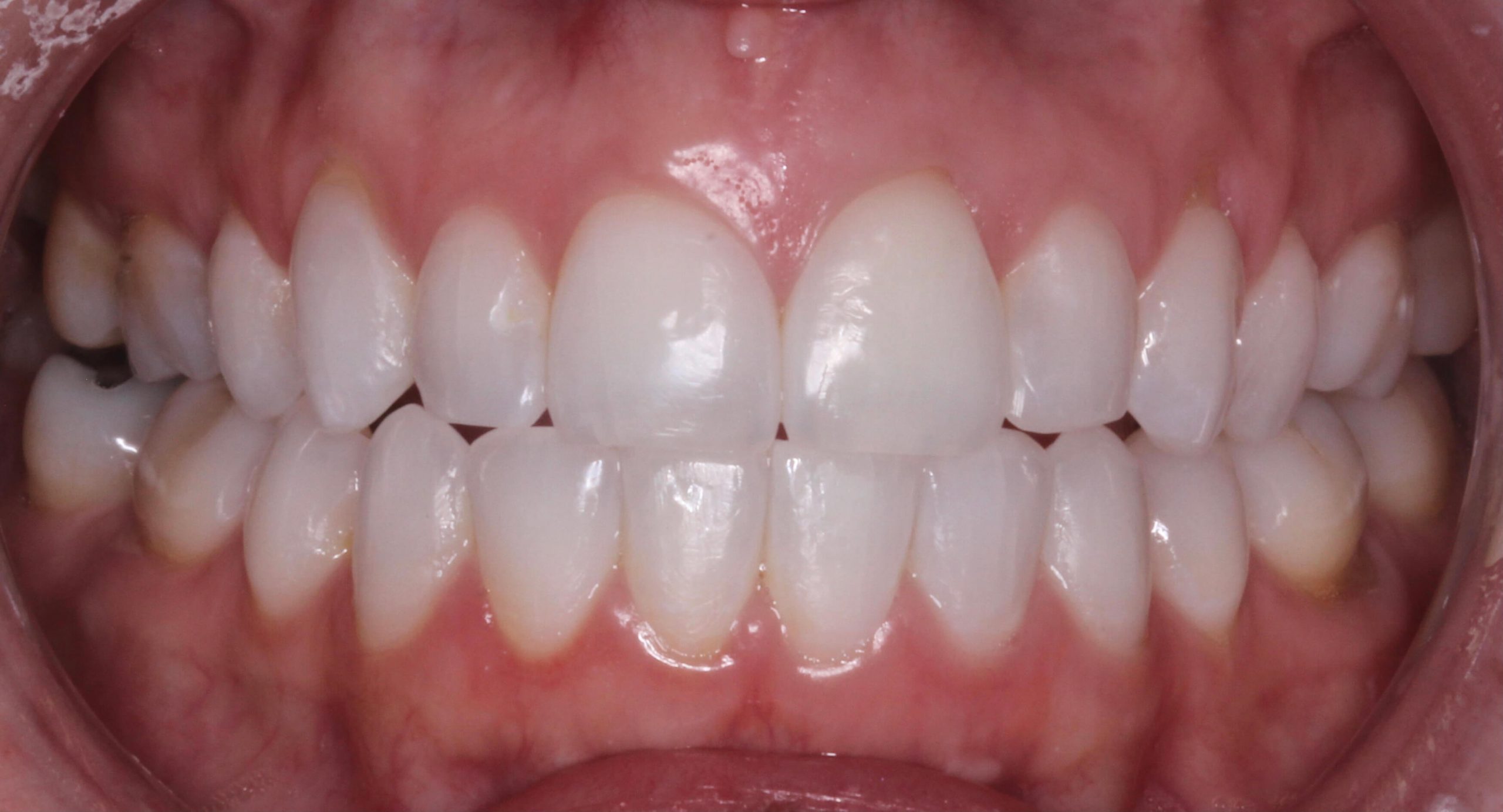 Invisalign - After 1