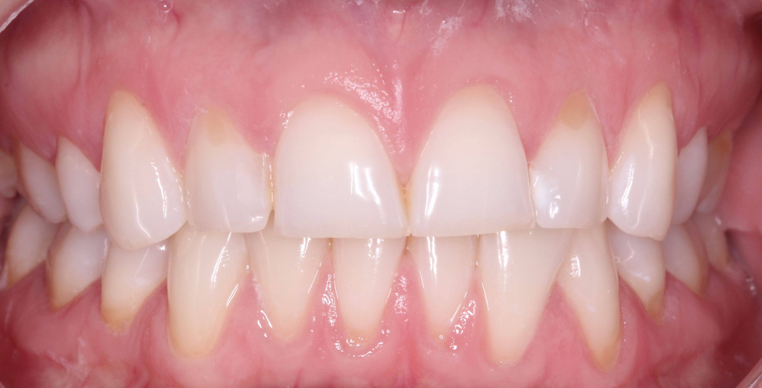 Invisalign - Before procedure 1