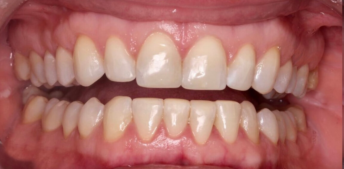 Invisalign - After