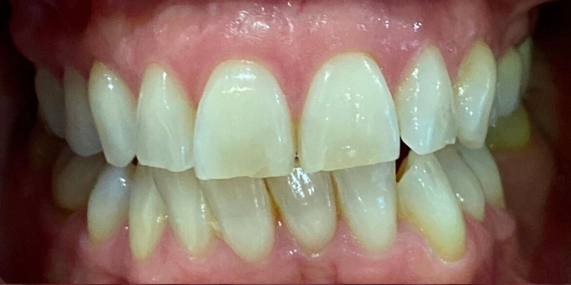 Invisalign - Before