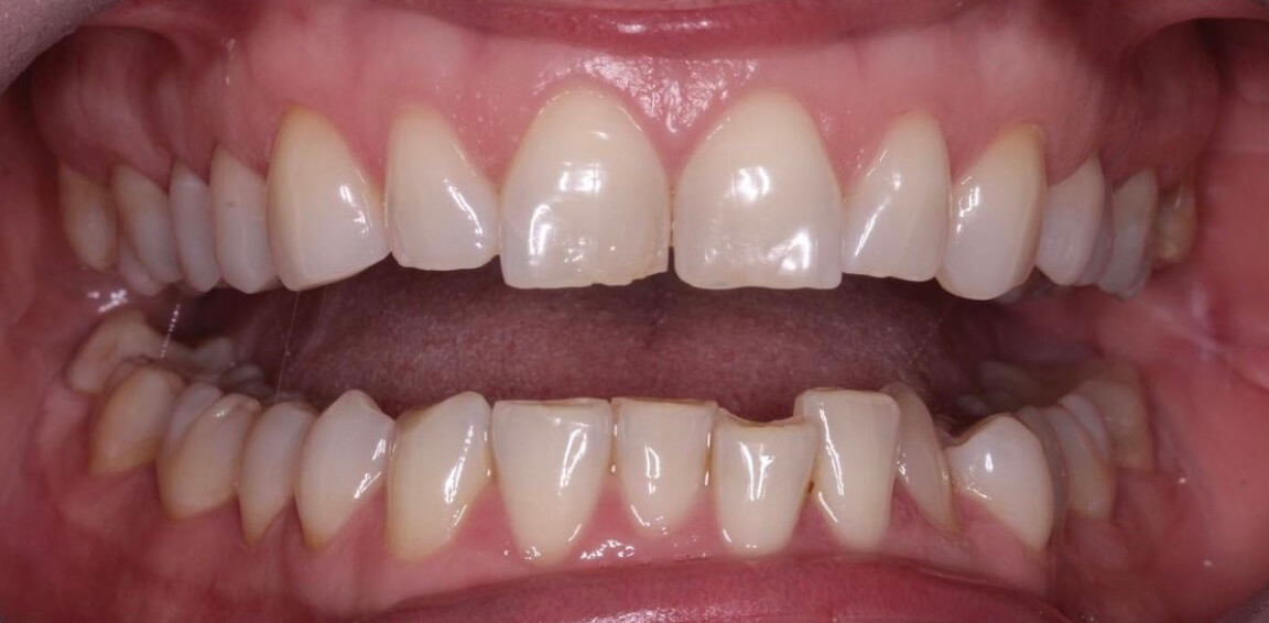 Invisalign - Before
