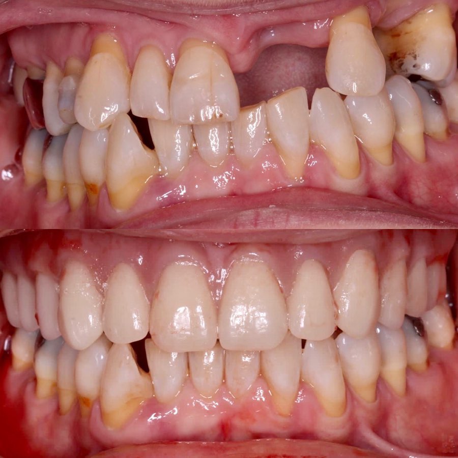 Missing Teeth