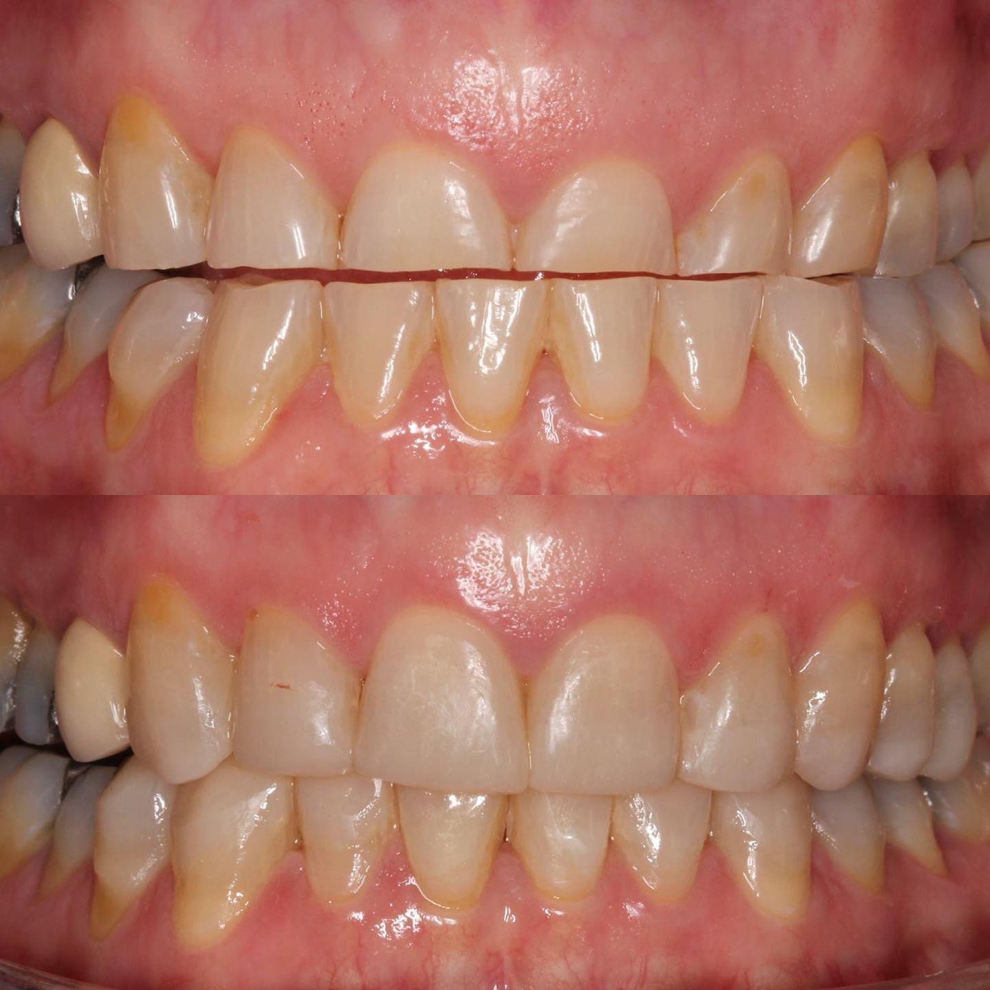 Tooth Decay and Worn Teeth