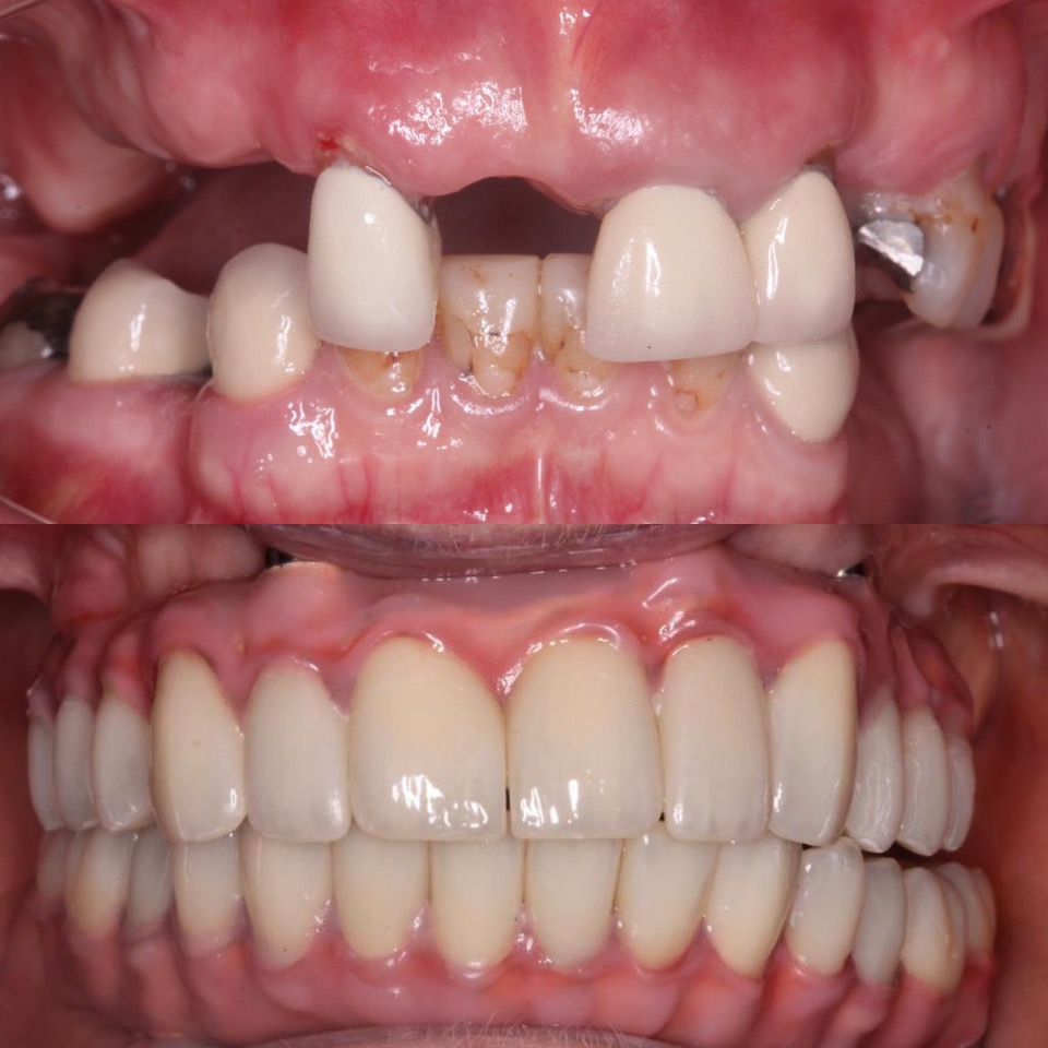 Dental Implant Dental Implant
